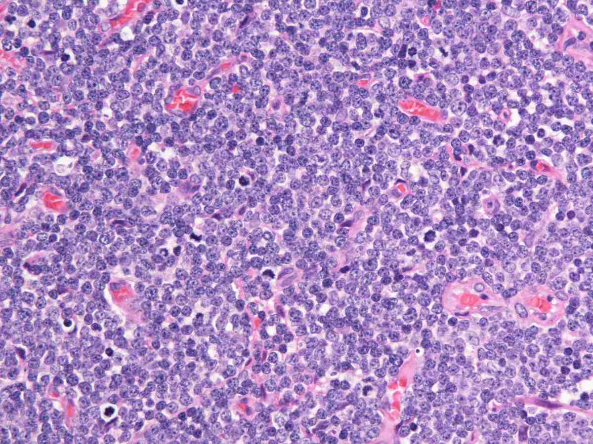Lymph node 2010 HE 40X